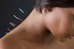 Experience The Healing Benefits Of Acupuncture at Cedros Natural Health Center(Up To 44% Off) - Second Medium