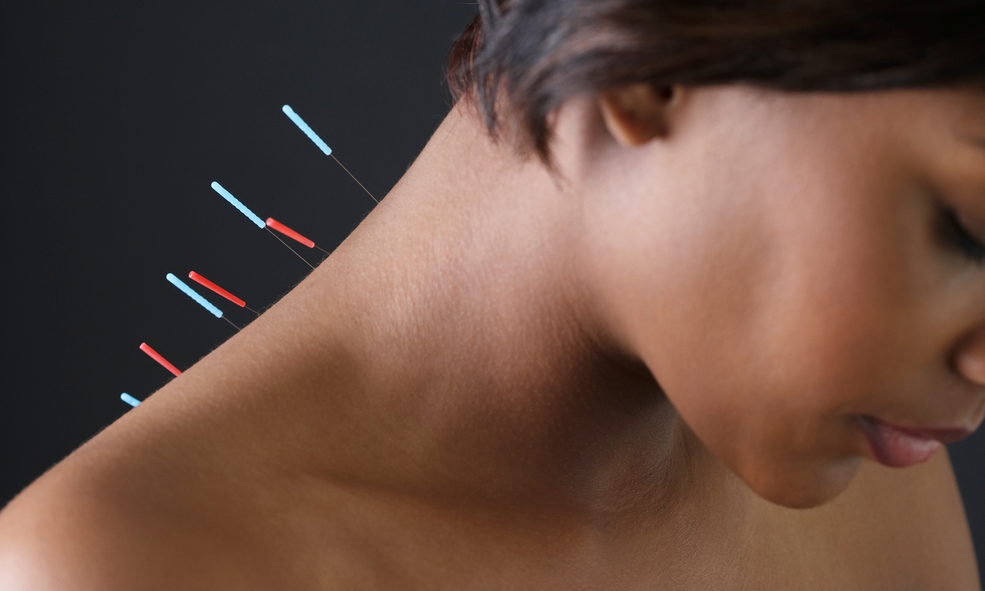 60 Min. Akupunktur inkl. Anamnese, Untersuchung & Beratung