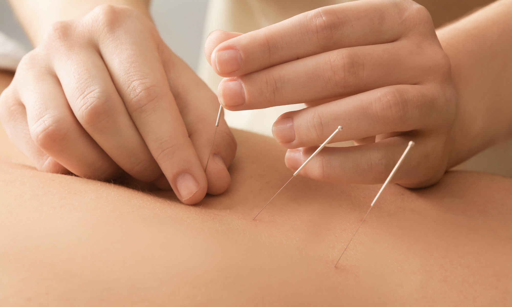Heal Naturally with One or Two Acupuncture Sessions
