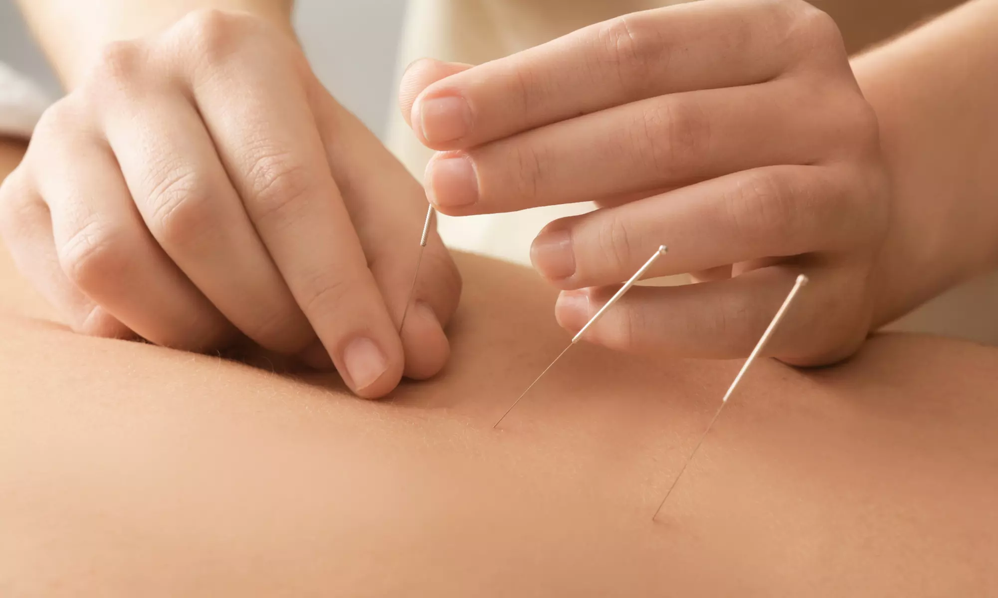 Restore Balance with One or Two Acupuncture Sessions at Active Sport & Spine Therapy (Up to 70%Off) - Primary Image