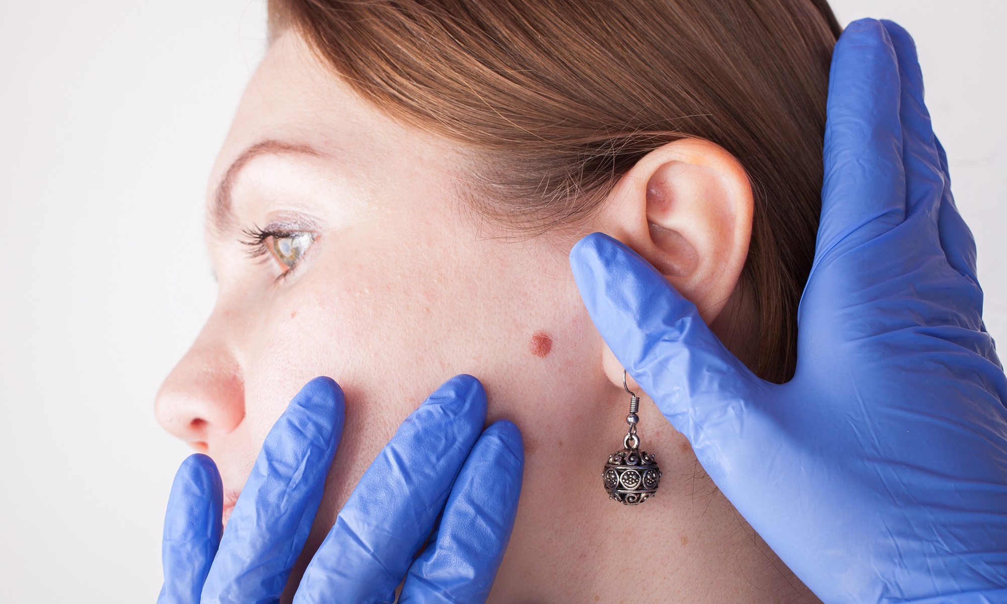 Smooth Skin with Wart Removal Treatment Options