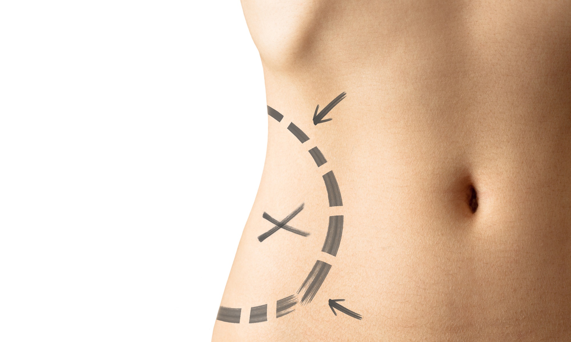 Achieve Sculpted Results W/ Body Contouring Treatment at Aviani Beauty