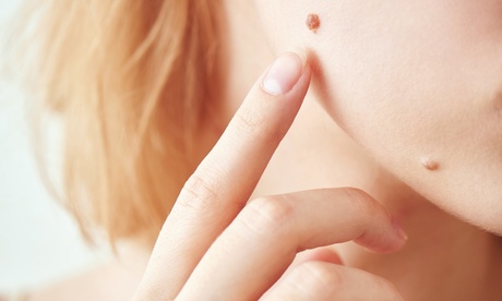 Fino a 7 asportazioni cutanee allo studio medico (sconto fino a 85%). Valido per 2 sedi