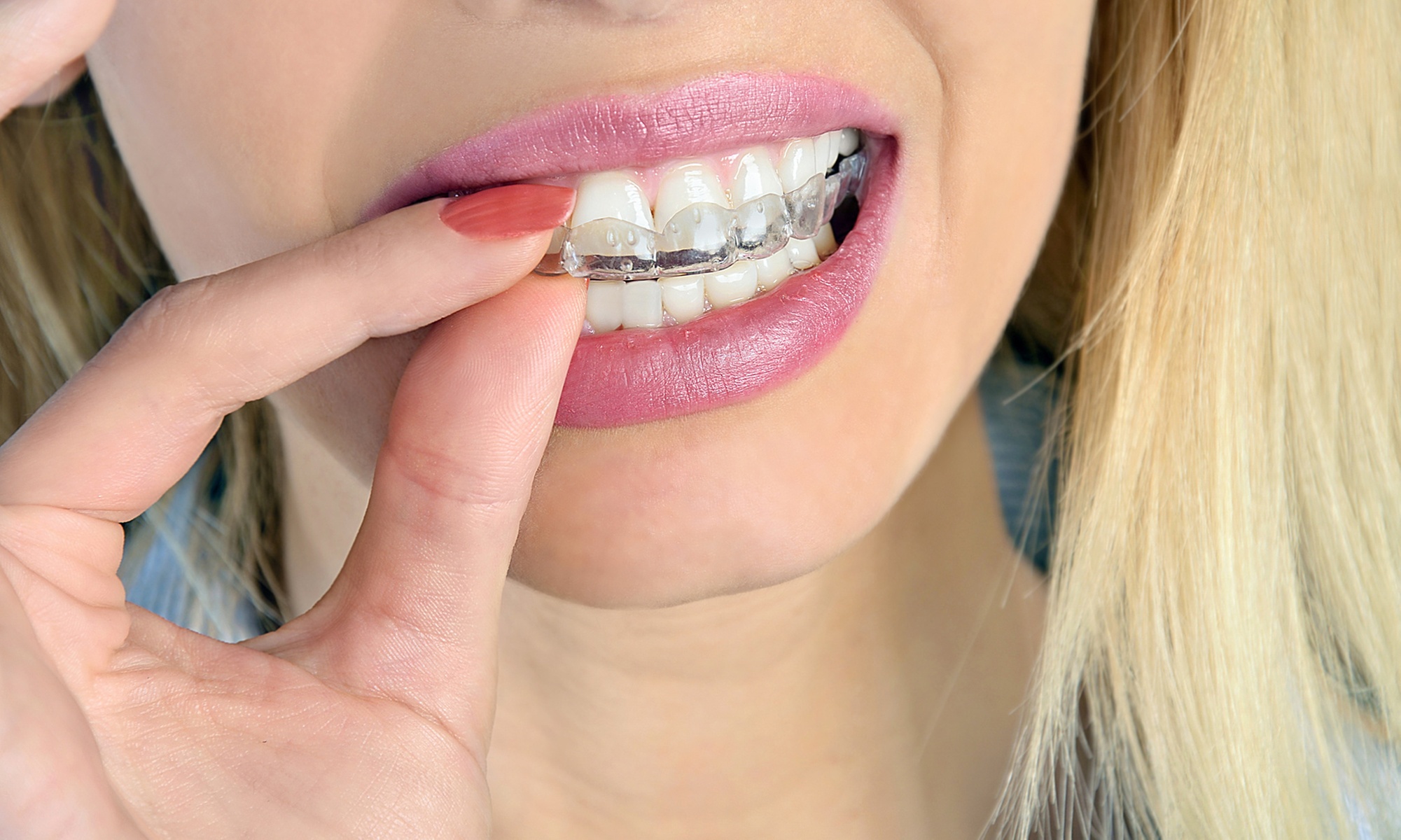 Transform Your Smile with One Traditional or Clear Retainers at Braces Invisalign (Up to 22%Off)