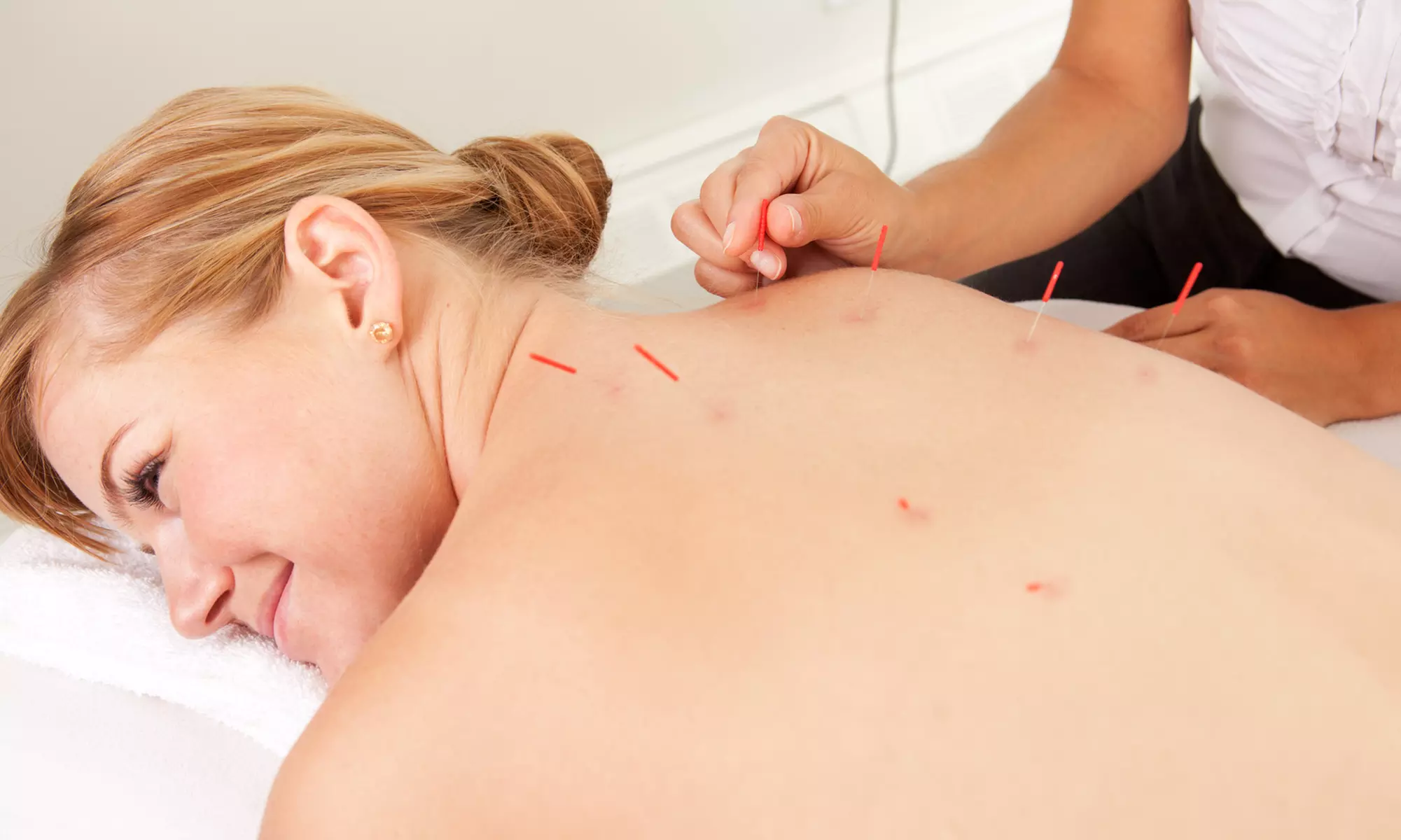 $19 for Acupuncture and Massage at Ping's Acupuncture Clinic, Eastwood - Primary Image