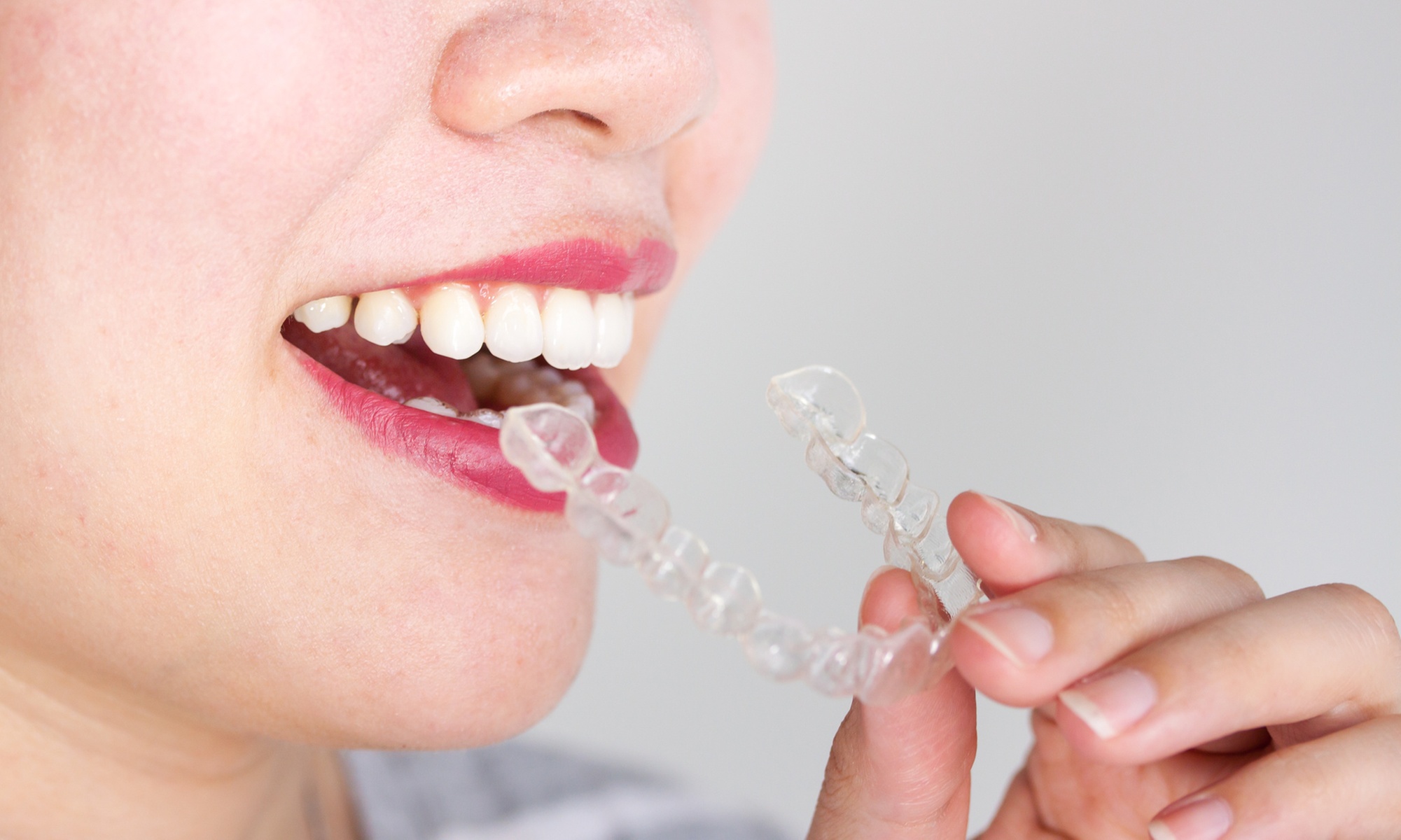 Transform your smile with $999 Invisalign credit at Frisco Dental Implant Center, tailored treatments, and up to 90% off - Primary Image