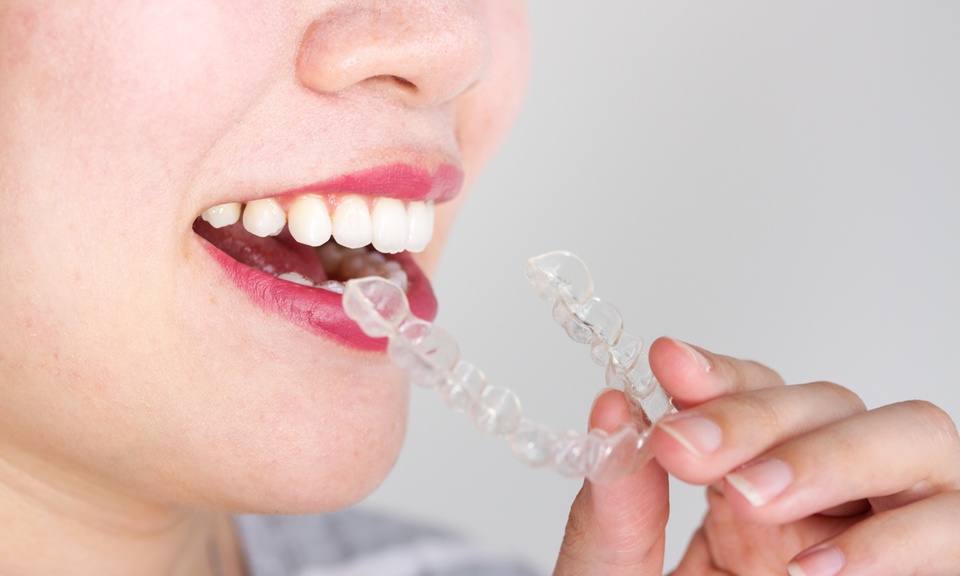 Cheap Invisalign Deals Near You | Groupon Coupons Inside