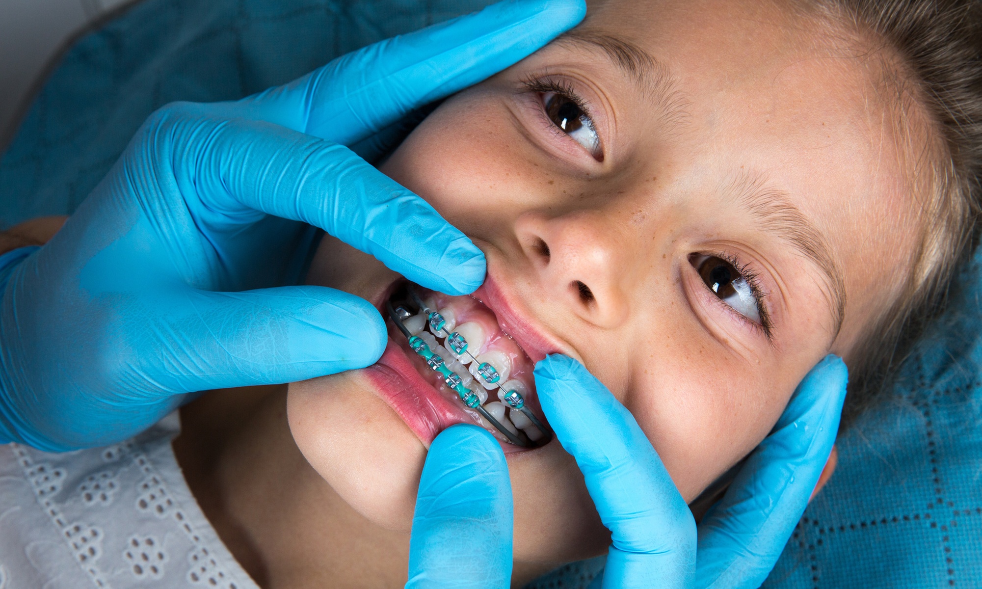 Brackets metálicos o de porcelana en 2 arcadas con estudio y limpieza