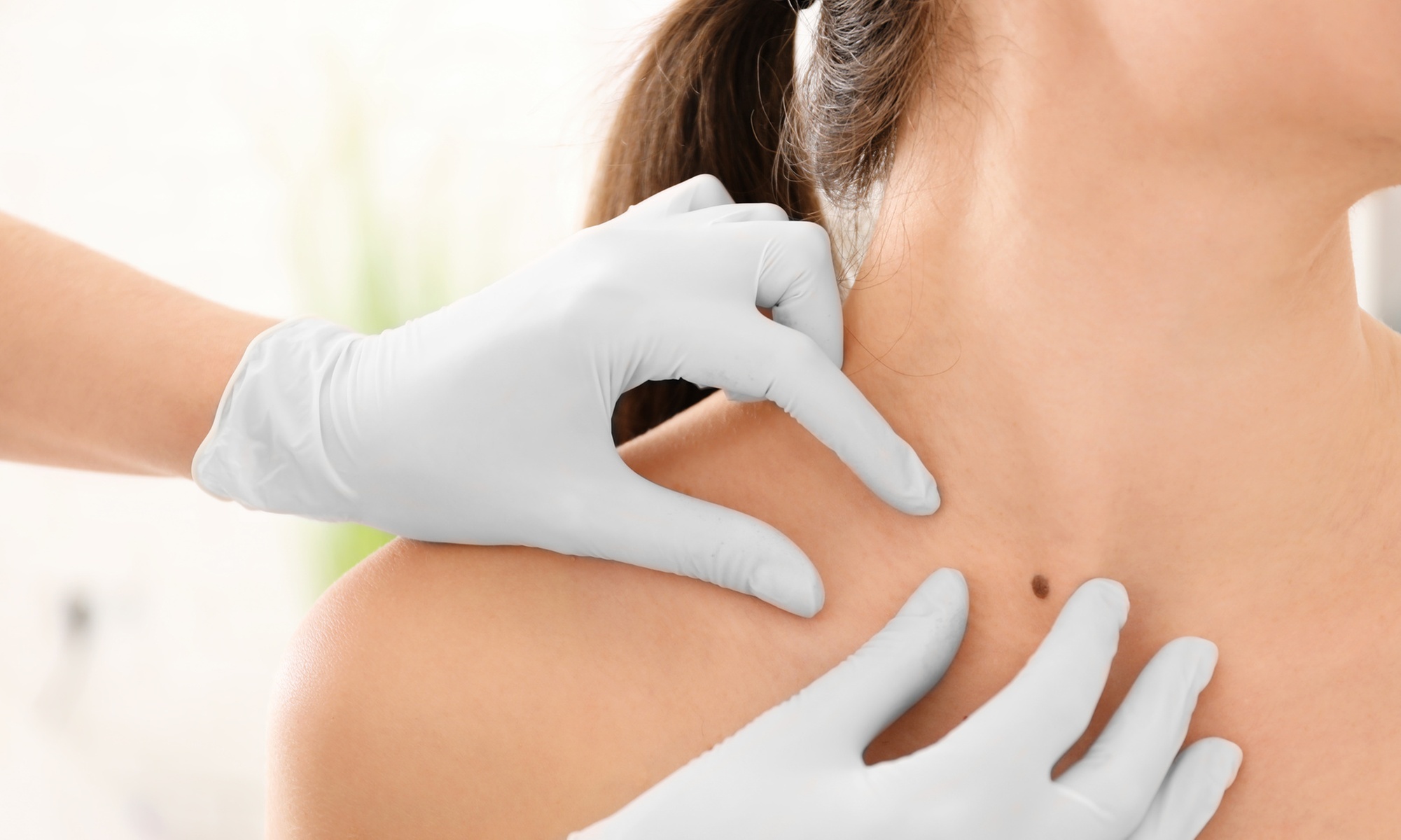 Non-invasive treatment for skin tags and sun spots removal