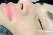 Glow Naturally: 1 or 3 Visits of 2 ML of Salmon DNA Injections (Full Face) At Refine Health (Up to 39% Off) - Second Medium