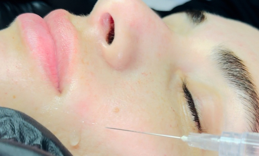 Image 4: Glow with 1 or 3 Visits of 2 ML of Salmon DNA Injections (Full Face)