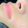 Image 4: Glow with 1 or 3 Visits of 2 ML of Salmon DNA Injections (Full Face)