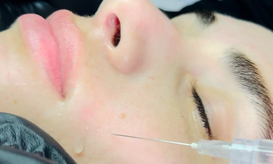 Glow with 1 or 3 Visits of 2 ML of Salmon DNA Injections (Full Face)