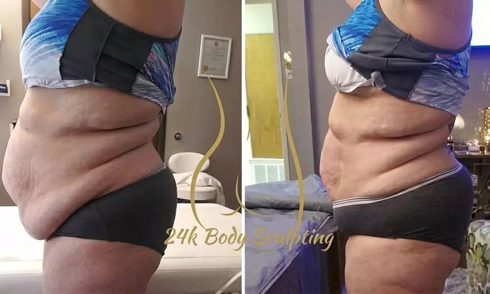 Transform w/ One, Two or Four 45 Minute Ultrasonic Cavitation Sessions