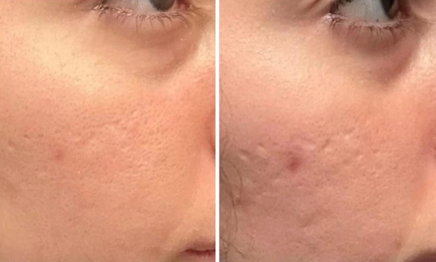 Image 4: One or Three Sessions Of Microneedling with Skin Nourishing Serum