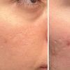 Image 4: One or Three Sessions Of Microneedling with Skin Nourishing Serum