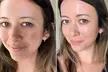 Rejuvenate Your Skin with One, Three, or Five Micro Needling Treatments at Skin by SJ (Up To  70% Off) - Second Medium