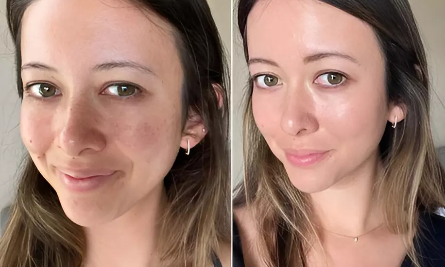 Get Smoother Skin with One, Three, or Five Micro Needling Treatments