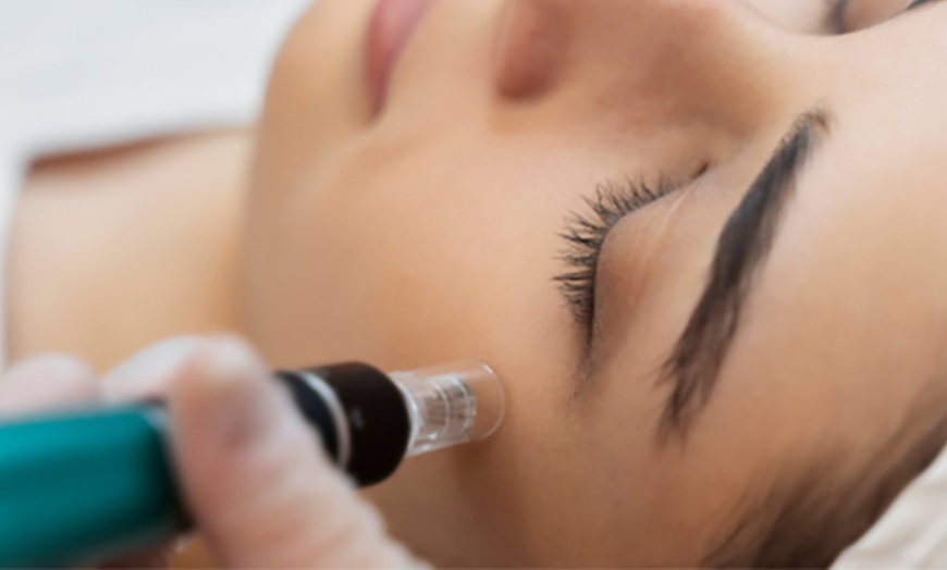 Image 2: Revitaliza tu rostro con una sesión de microneedling facial