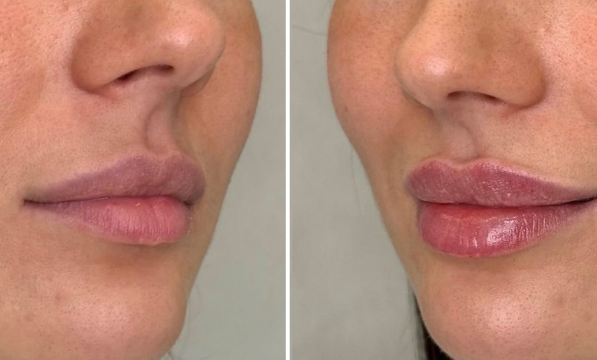 Image 2: Transform Smile: 0.5-, 1-, or 2-ml Dermal Filler or Dissolver & Refill