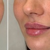Image 2: Transform Smile: 0.5-, 1-, or 2-ml Dermal Filler or Dissolver & Refill
