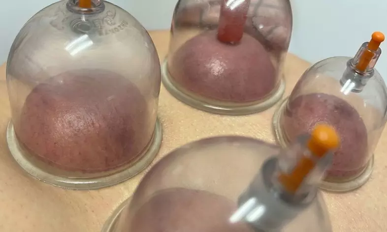 Relax with One, Three or Five Wet Cupping Sessions ( 1 Hour Each)