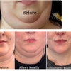 Image 2: Kybella Injections to Help Eliminate Double Chin Fat 
