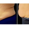 Image 5: 4 or 6 30-Minute Cavitation / 4 60-Minute Custom Ultrasonic Cavitation