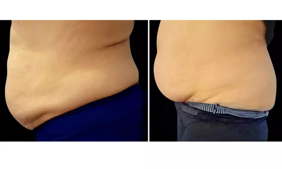 4 or 6 30-Minute Cavitation / 4 60-Minute Custom Ultrasonic Cavitation