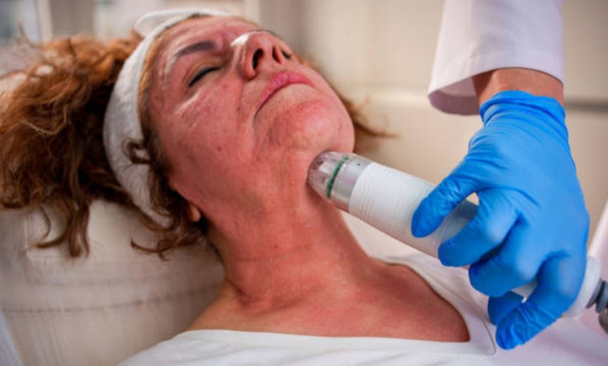 Image 9: Hyaluronpen con hidratación o relleno de labios y reafirmación facial