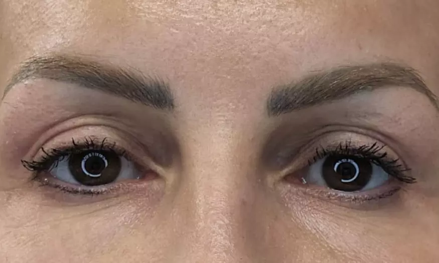 Plasmalift: Oberlidstraffung & Lifting mit Skin Corrector für 1 Person