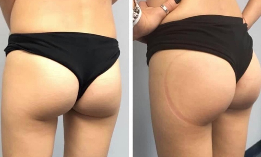 Image 4: Forfait épilation à la cire pour une peau nette et douce
