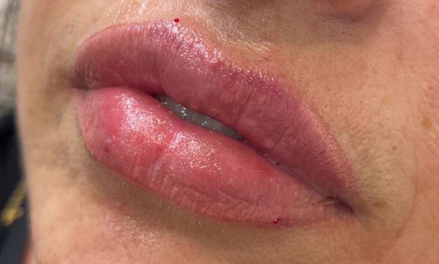 Image 7: Lip Enhancements with 0.5ml or 1ml Filler by UK-Qualified Experts