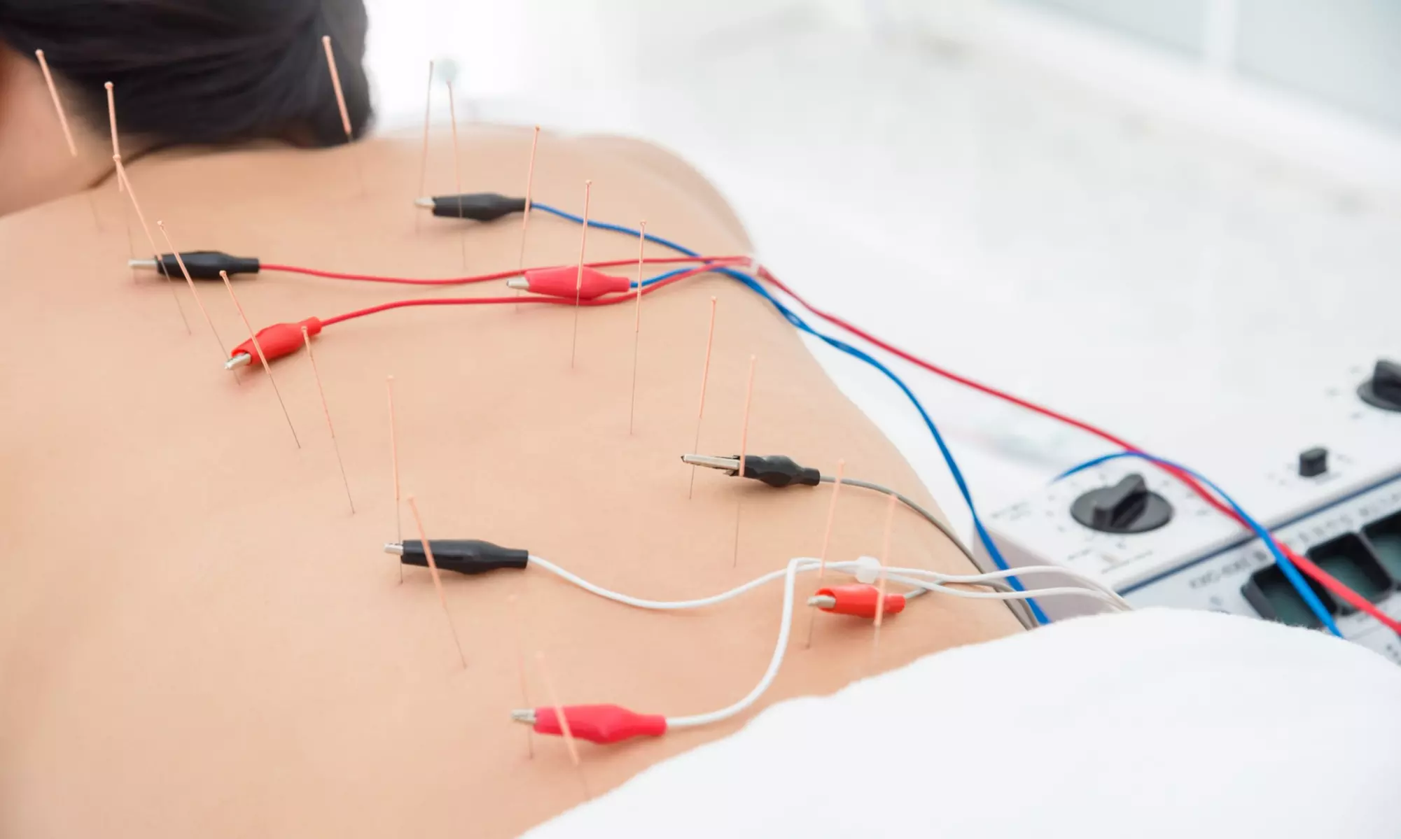 Experience up to 50% off with Van Ness Chiropractic's pain relief wellness exam featuring chiropractic and acupuncture sessions - Second Medium