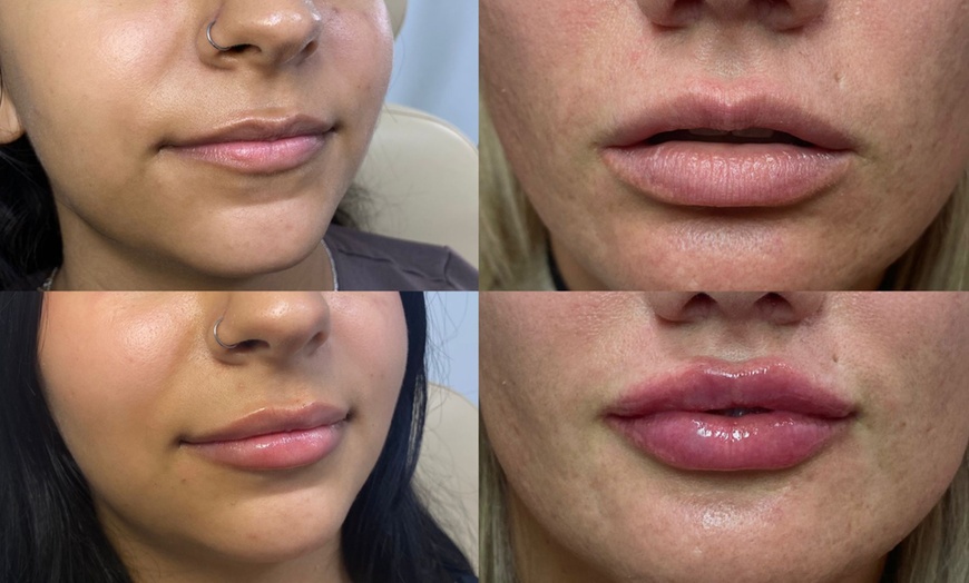 Image 2: Get a Half Syringe or One of the Dermal Fillers