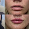 Image 2: Get a Half Syringe or One of the Dermal Fillers