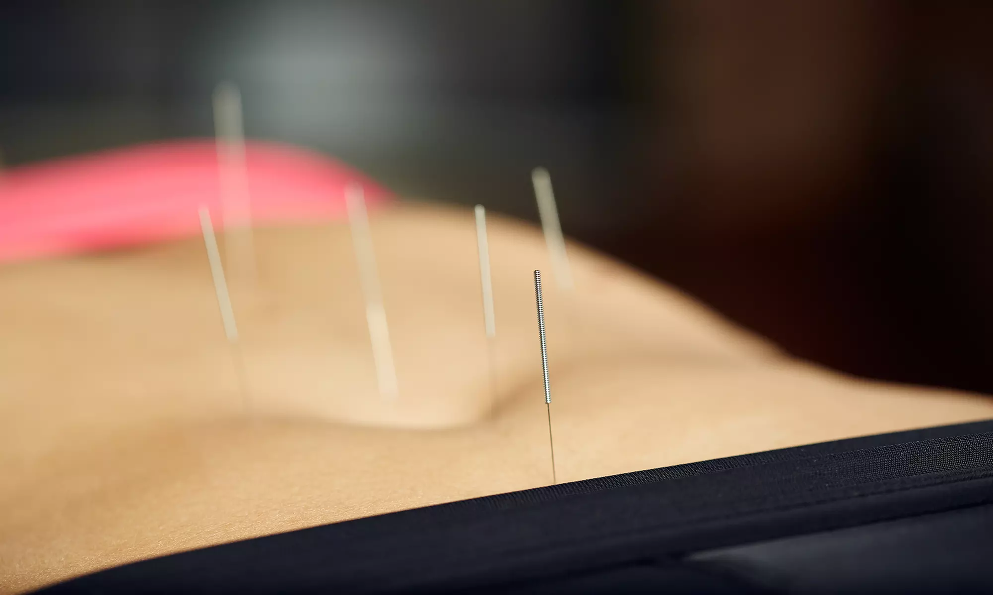 $40 for $100 Worth of Acupuncture — Sunshine Acupuncture & Herbal Clinic - Primary Image
