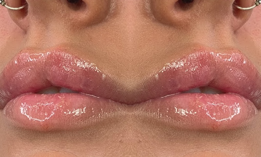 Image 2: Transform Your Lips: Russian Lip Filler with Consultation