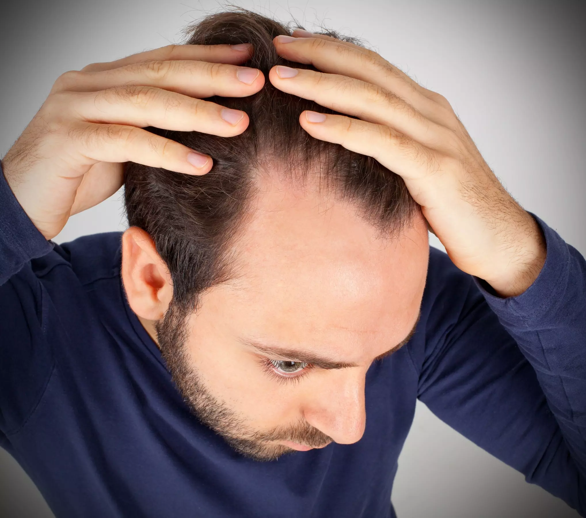 Finasteride Supply for Hair Loss Prevention and Supplement Package