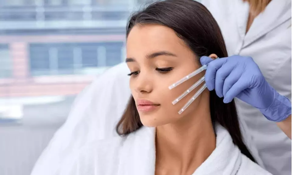 Lifting facial: potencia tu belleza natural con 6 o 12 hilos tensores