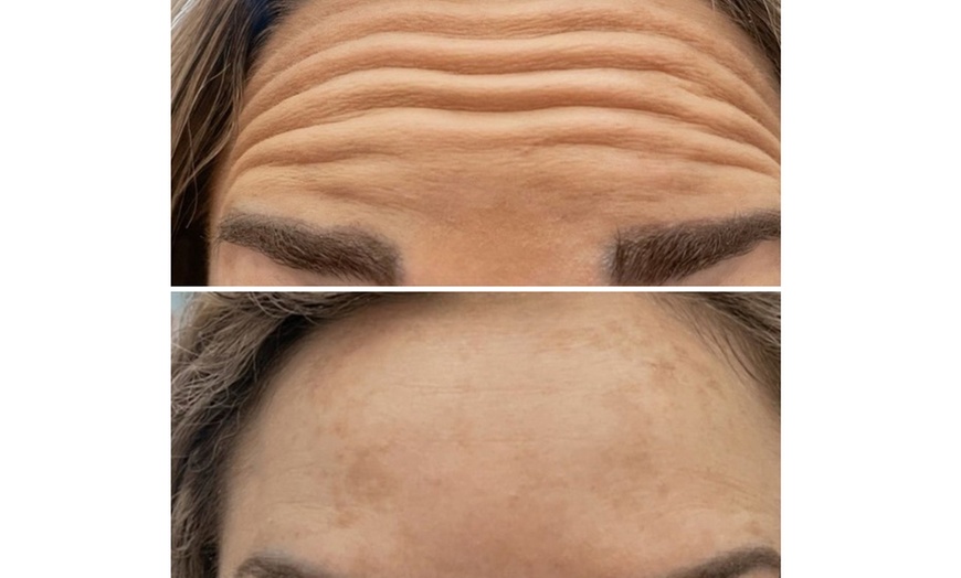 Image 5: Up to 29% Off on Radio Frequency Skin Tightening at GB Luxe Medic