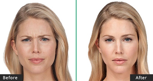 Rejuvenate with 20 or 40 Units of Botox