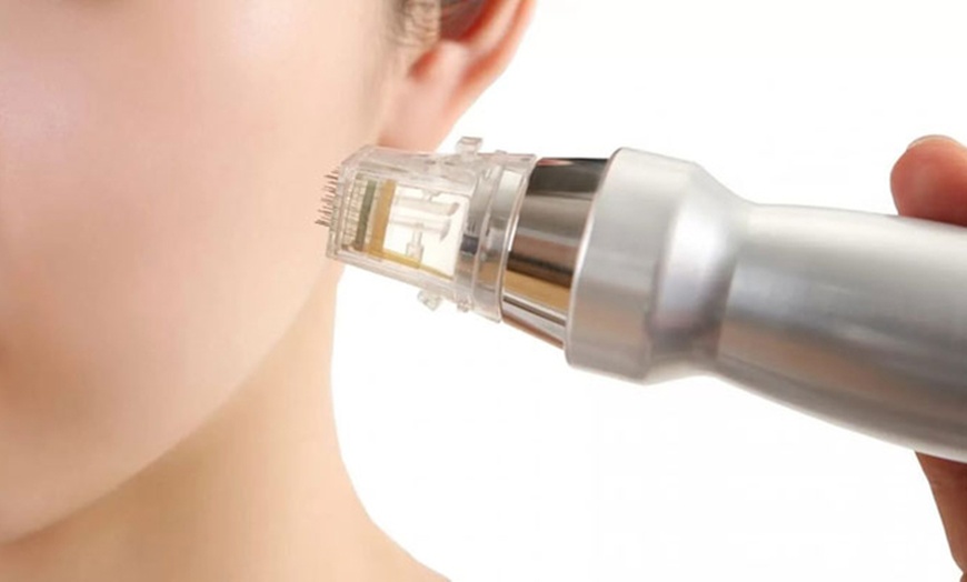 Image 1: Stretch Mark Removal w/ Micordeeling + Carboxytherapy