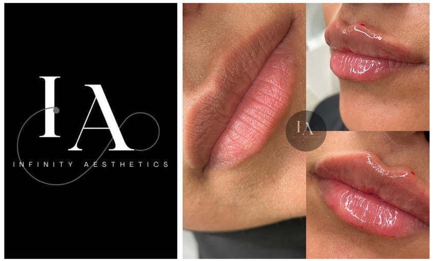 Image 7: Enhance Your Lips with 1.1ml Filler and Expert Consultation