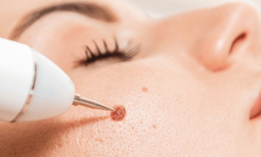 Image 1: Up to 30% Off on Mole / Growth Removal at Sugar'n Sculpt Westlake