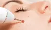 Up to 30% Off on Mole / Growth Removal at Sugar'n Sculpt Westlake