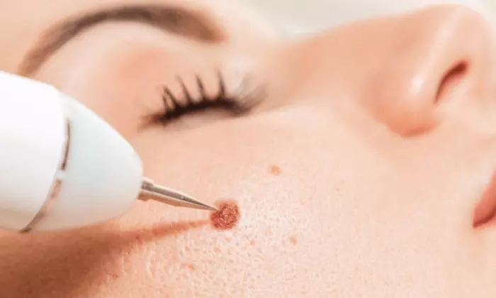 Spotless Skin: Remove 1, 3, or 5 Skin Tags, Age Spots & More 