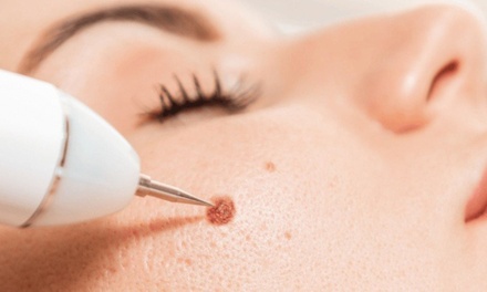1 Skin Tag, Cherry Angioma, Age spot or Milia for 2mm Treatment - Sugar'n Sculpt Westlake