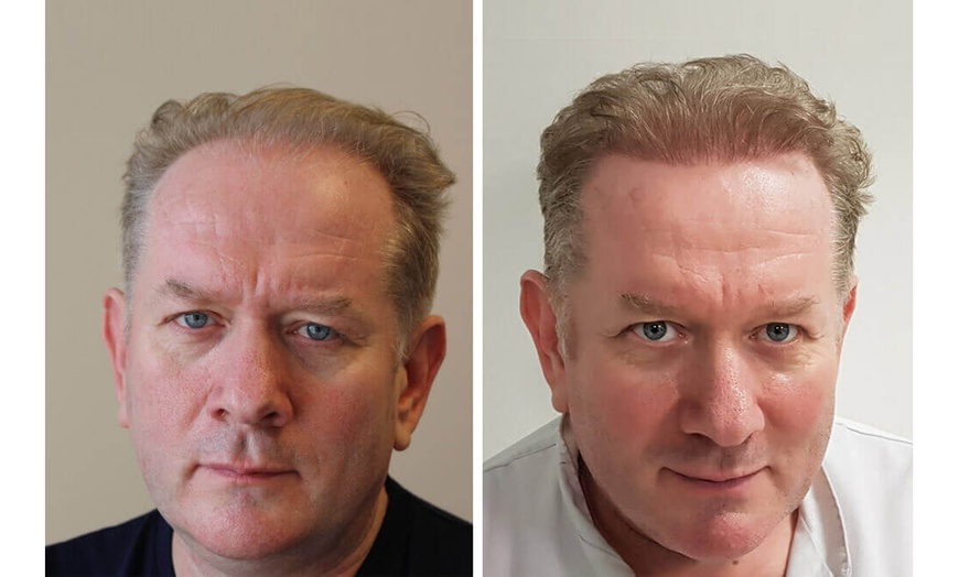 Image 5: Transform Your Look with 1000, 2000, or 3000 Graft Transplant