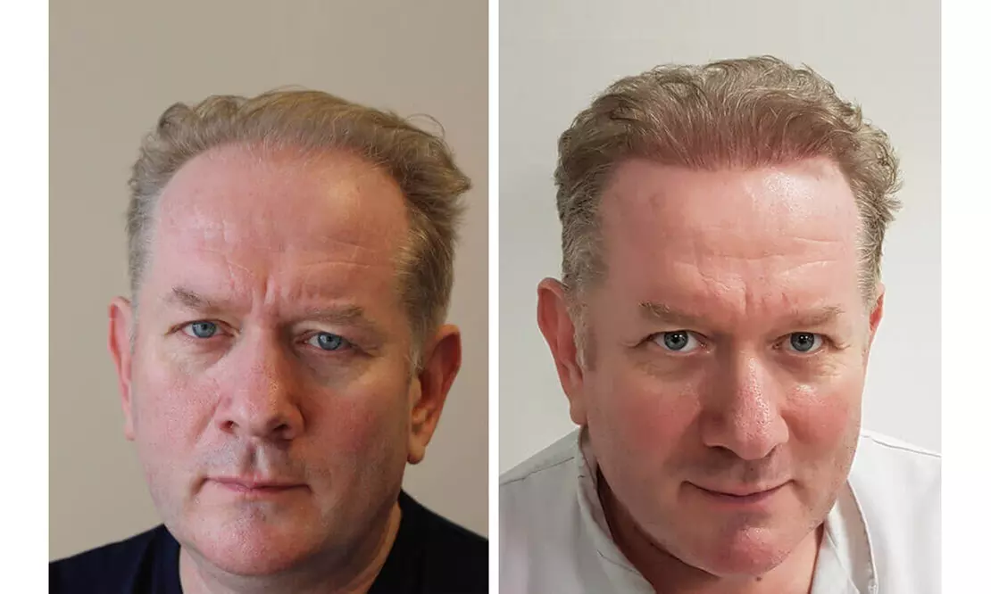 Up to 54% Off on Hair Restoration - Implants at My Health and Wellbeing Clinic